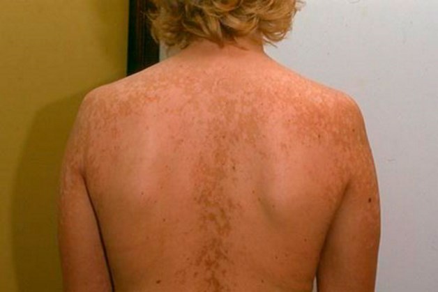 как лечить грибок на спине