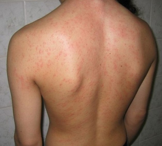 крапивница на спине