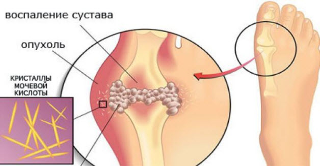 Кристаллы мочевой кислоты