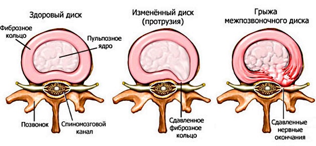 межпозвоночная грыжа