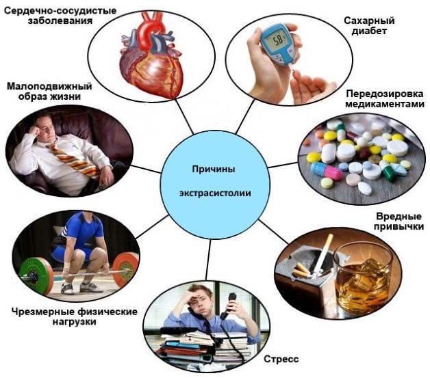 наджелудочная экзосистолия