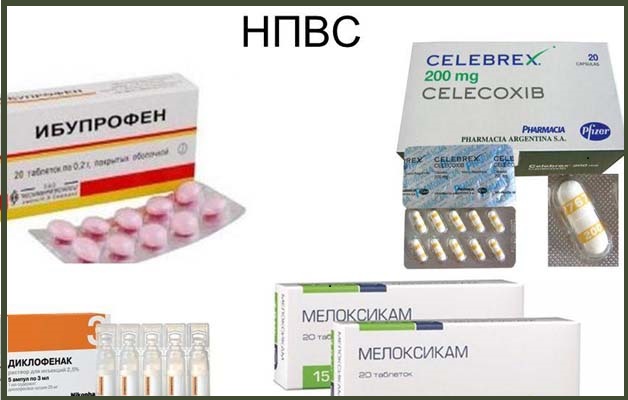 НПВП при плечевом артрозе