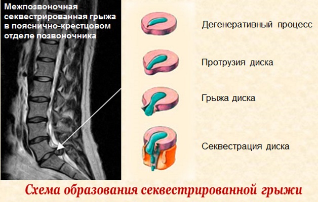 образование секвестра