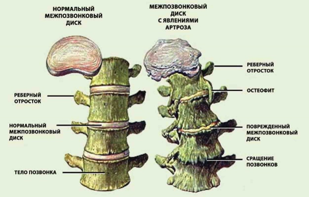 остеохондроз