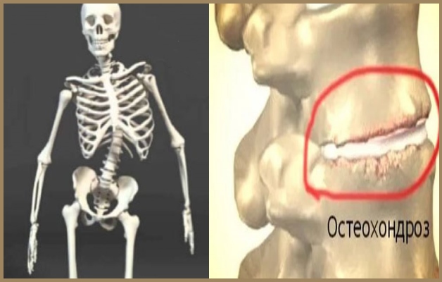 остеохондроз и сколиоз