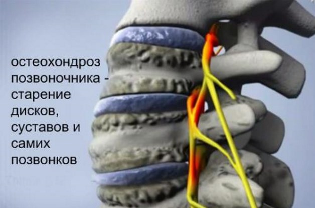 остеохондроз позвоночника факторы риска