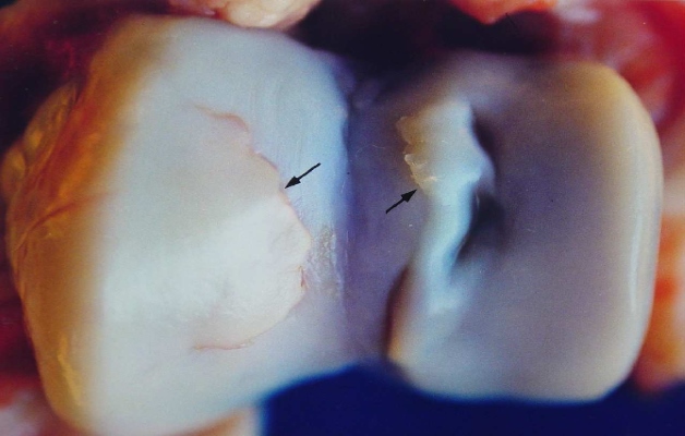 остеохондроз тазобедренного сустава