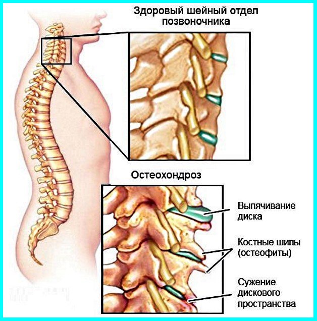 поясничный остеохондроз