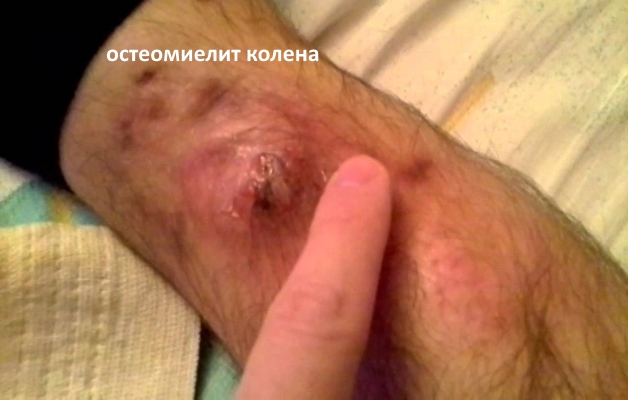 остеомиелит колена