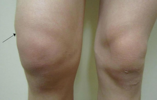 Отечность сустава