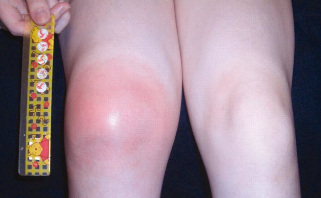 Отекшее колено