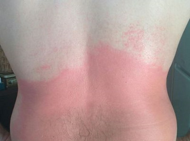 ожог от финалгона