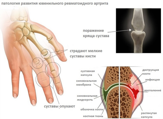 Патология развития ювенильного артрита