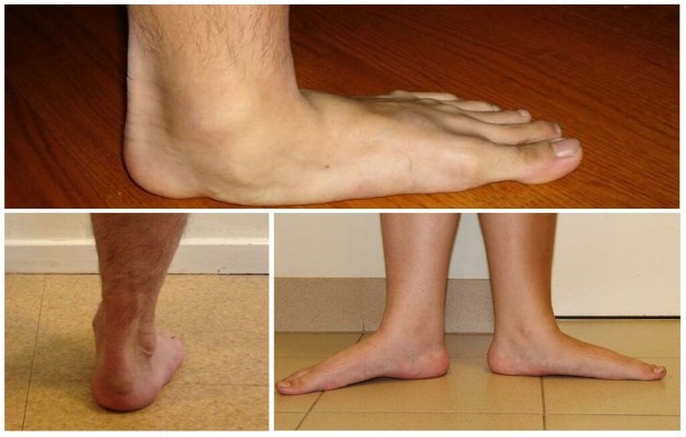 плоскостопие