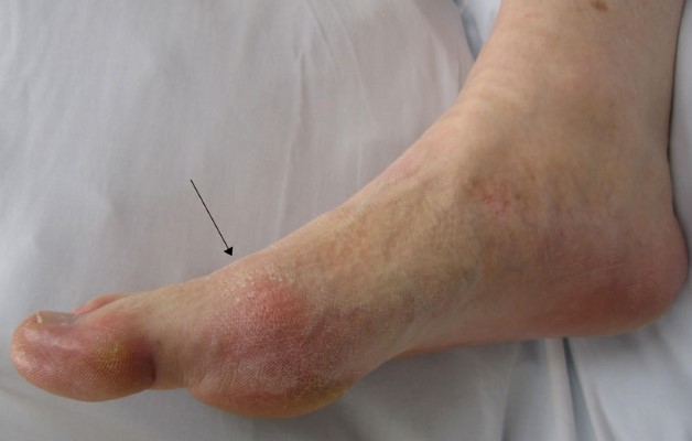 подагра на ноге