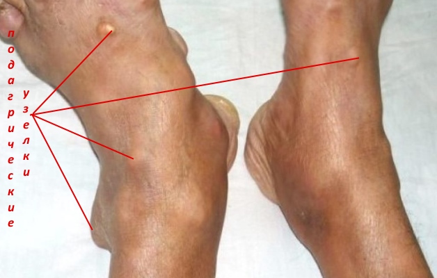 подагра стоп