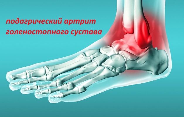 подагрический артрит голеностопного сустава