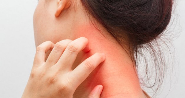 покраснение и зуд