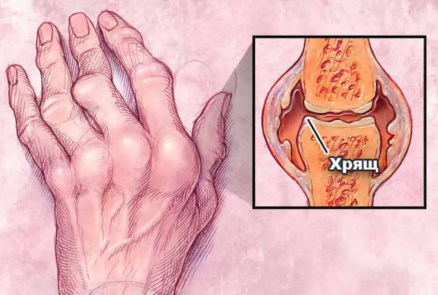 Пораженный сустав