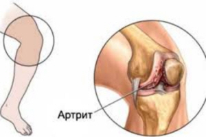 Пораженное колено