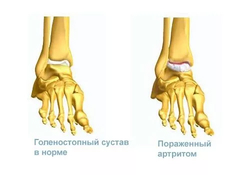 Пораженный голеностоп