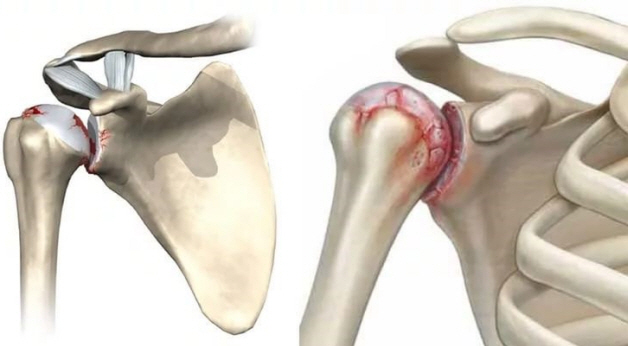 Пораженный сустав плеча