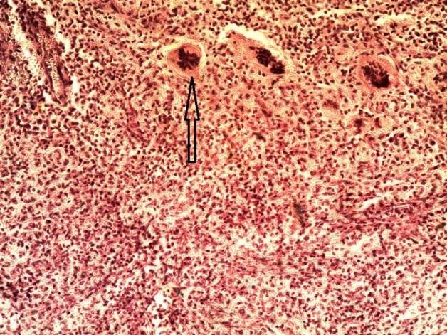 Порок сердца при ревматоидном артрите