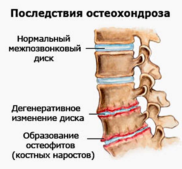 последствия полисегментарного остеохондроза