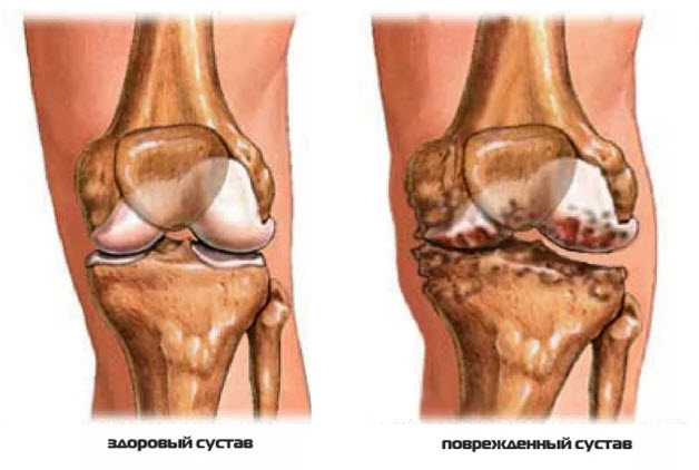 Поврежденный сустав