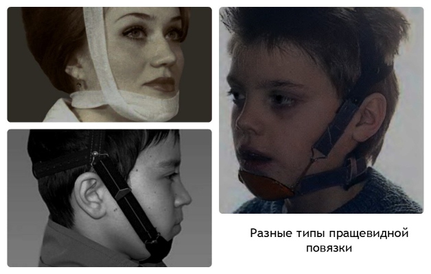 пращевидная повязка