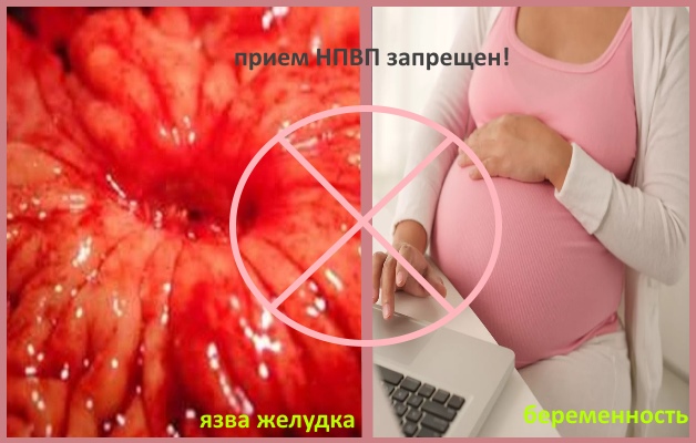 противопоказания к приему НПВП