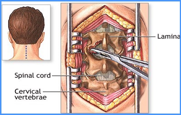 разрушение позвоночника