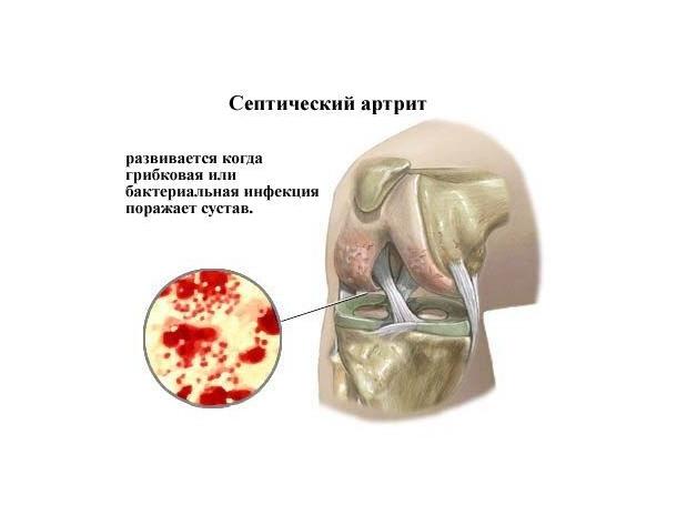 Причины болезни