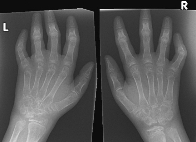 Рентген кисти руки
