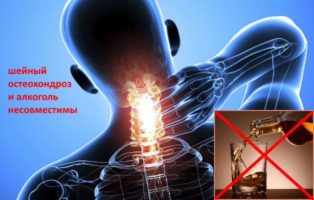 несовместимость шейного остеохондроза и алкоголя