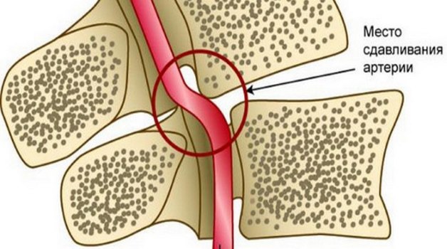 сдавливание позвоночной артерии