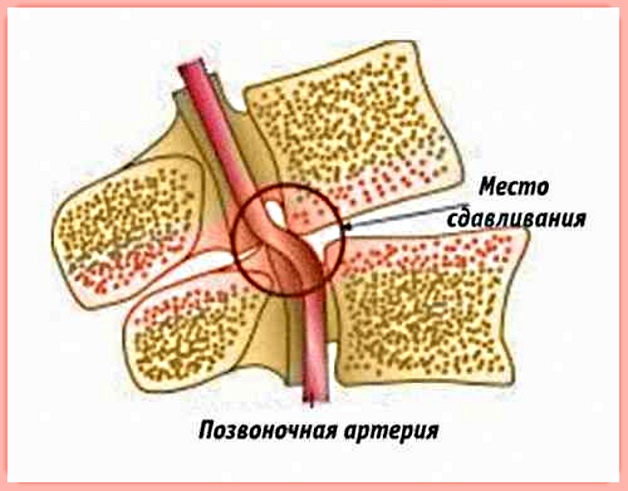 сдавливание позвоночной аретрии при шейном остеохондрозе
