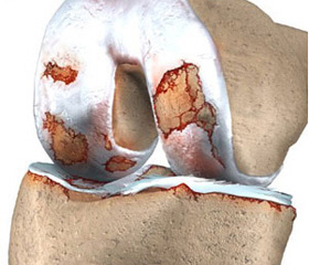 Пораженный сустав