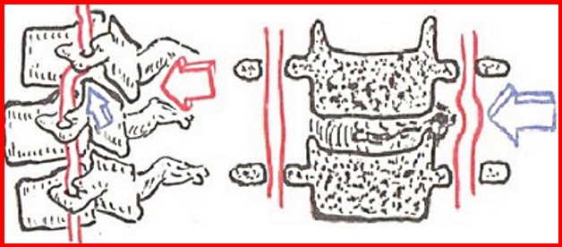 шейный остеохондроз и гипертония