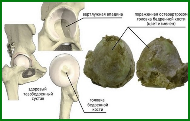 симптомы коксартроза