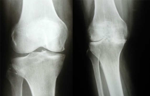 симптомы локтевого артроза