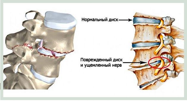 симптомы полисегментарного остеохондроза