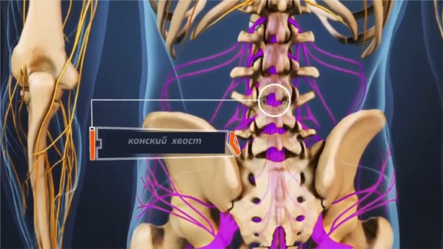 синдром конского хвоста