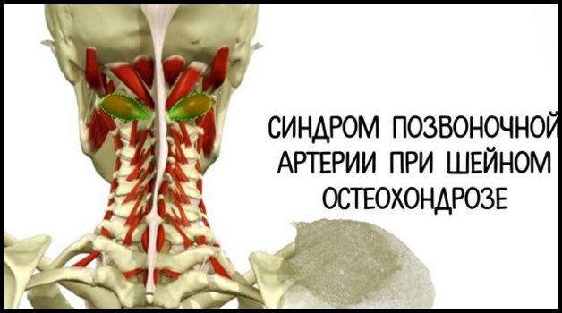 синдром позвоночной артерии