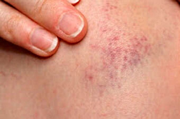 синяки от неправильного введения