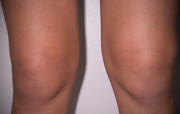 синовит коленного сустава