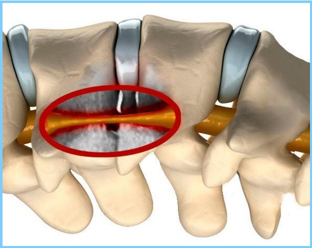сужение канала