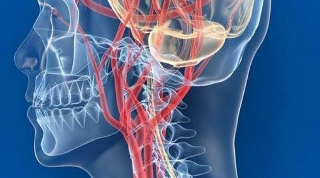 синдром позвоночной артерии