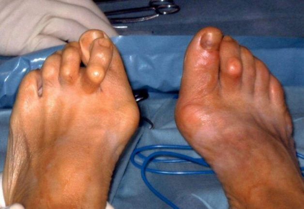 Тофусы на ногах