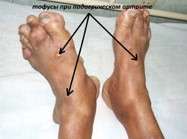 Тофусы при подагрическом артрите